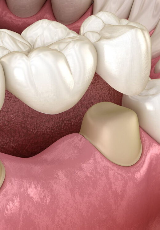 Dental crown model displayed on pink gum tissue showing tooth restoration procedure.
