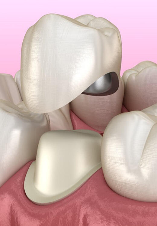 Dental crown restoration procedure showing tooth preparation and ceramic crown placement on pink background.