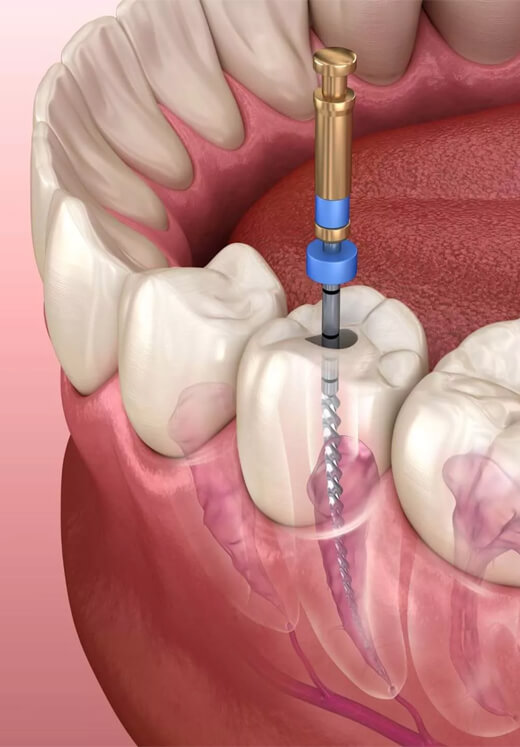 Dental professional administering anesthetic injection to patient's gum during oral procedure.