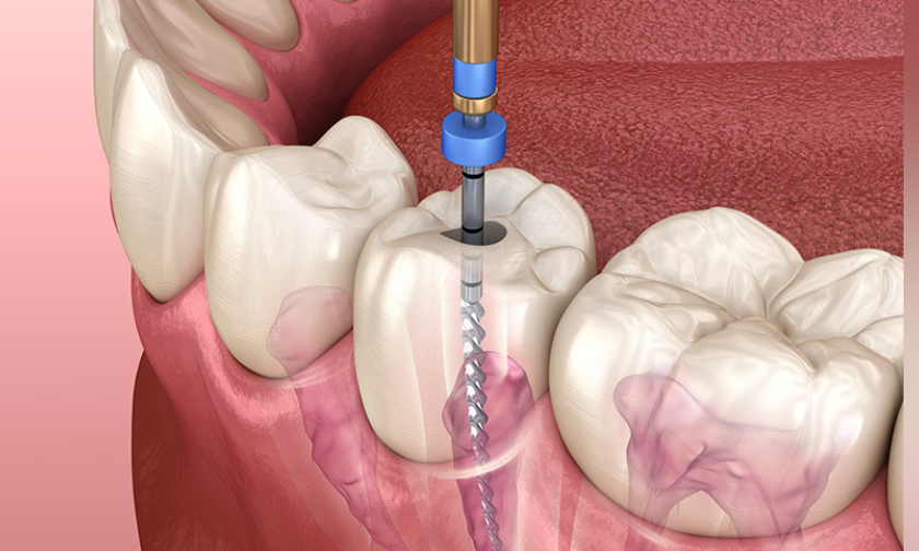 Featured image for “Tips To Prevent Getting A Root Canal”