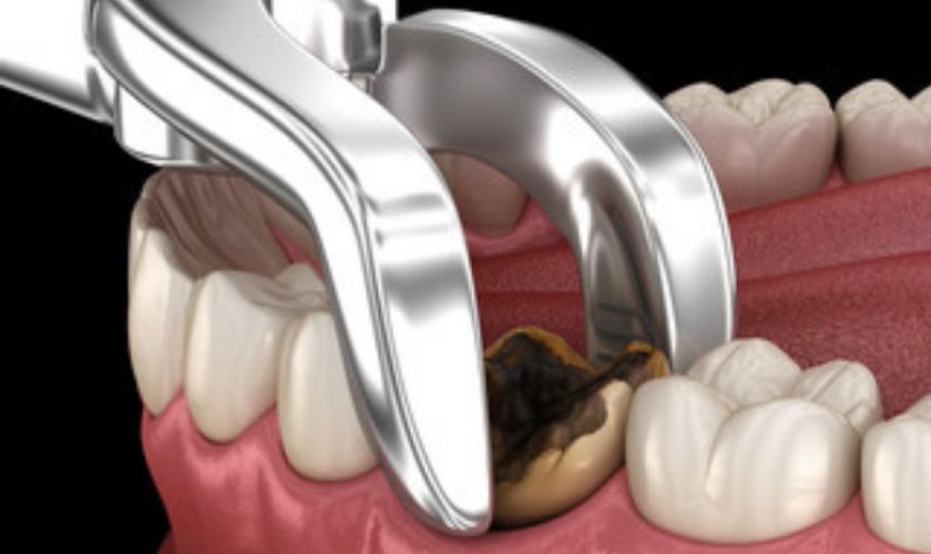 tooth extraction