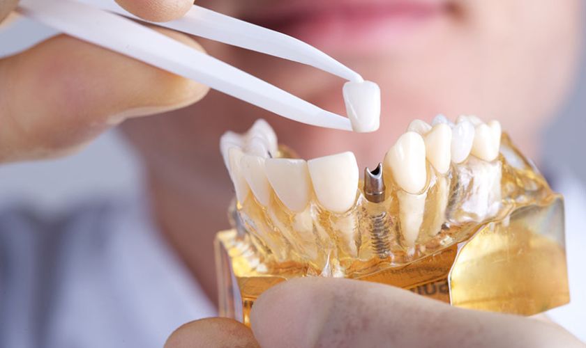 Dental Implant Surgery Complications And Their Solutions