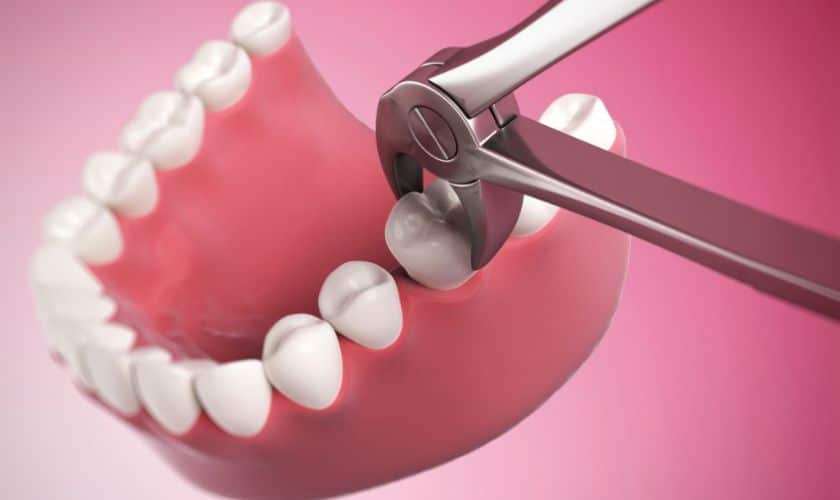 Safe and Effective Tooth Removal: Comprehensive Dental Solutions - Hurd Family Dental