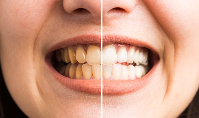 cosmetic dentistry in lees summit, missouri
