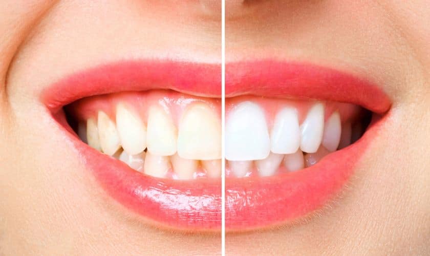Teeth Whitening Tips
