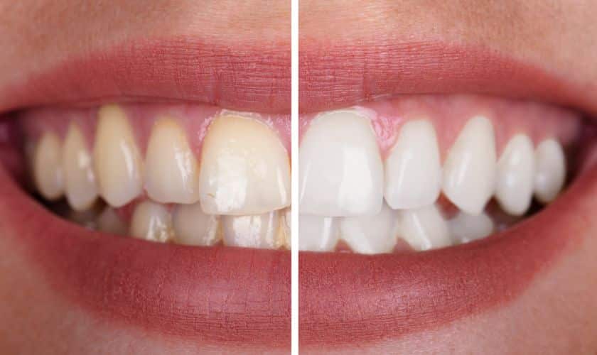 Before and after comparison of teeth whitening results showing yellowed teeth transformed to bright white teeth.