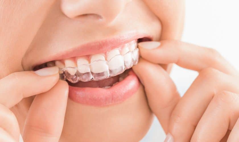Invisalign after teeth whitening - Hurd Family Dental