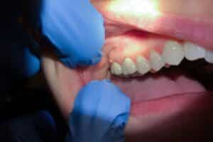 Emergency Dentist in Lee s Summit MO at Hurd Family Dental