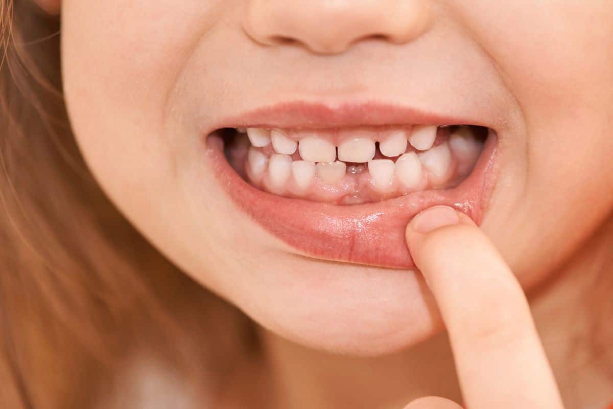 Invisalign After Dental Restorations in Invisalign After Dental Restorations in Lee's Summit MO at Hurd Family Dental