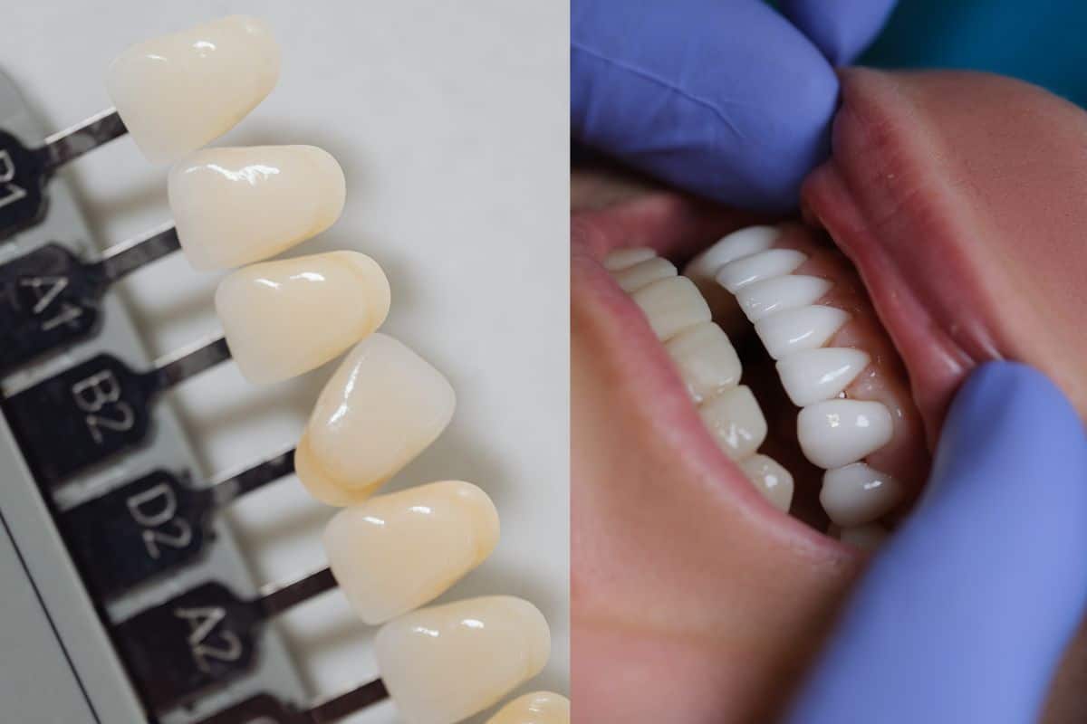 Prevent Side Effects Of Veneers in Lee's Summit, MO at Hurd Family Dental