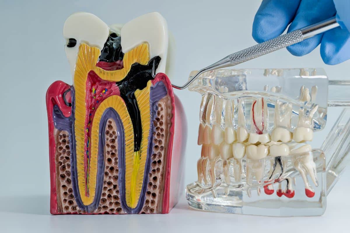 Root Canal Therapy in Lees Summit