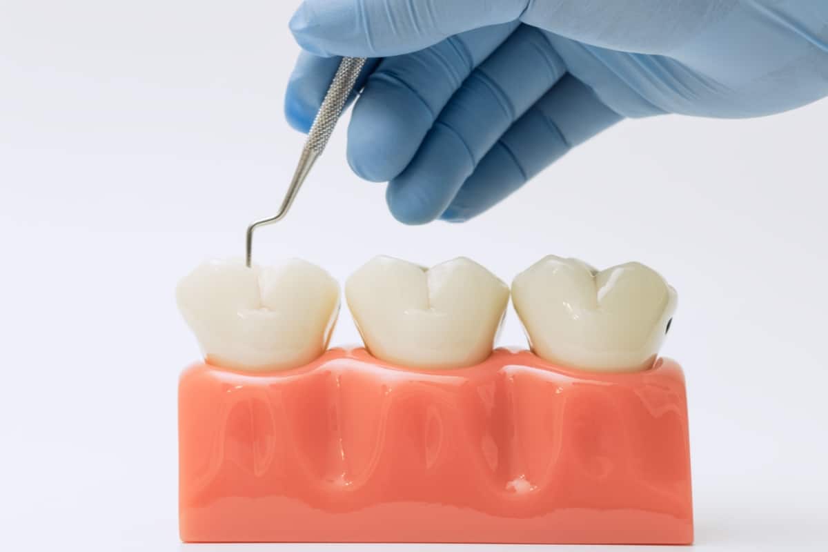 Dental Crowns in Lees Summit