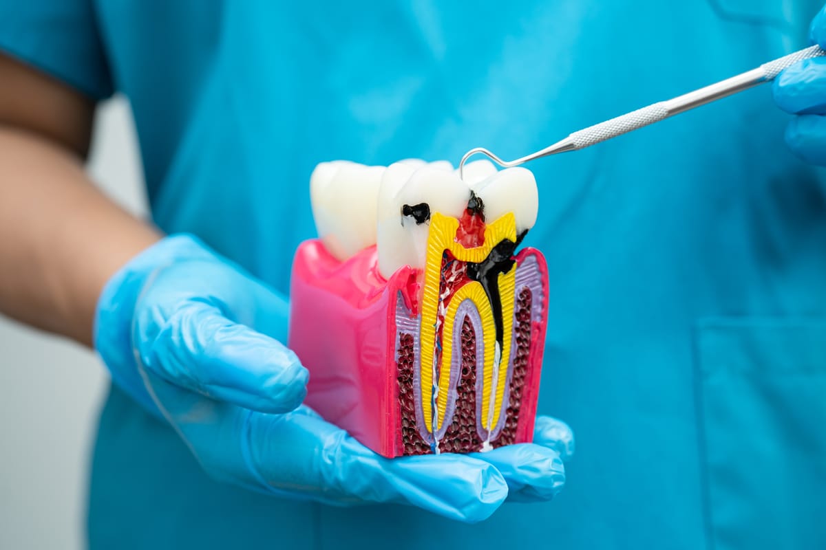 Root Canal Therapy Lee's Summit