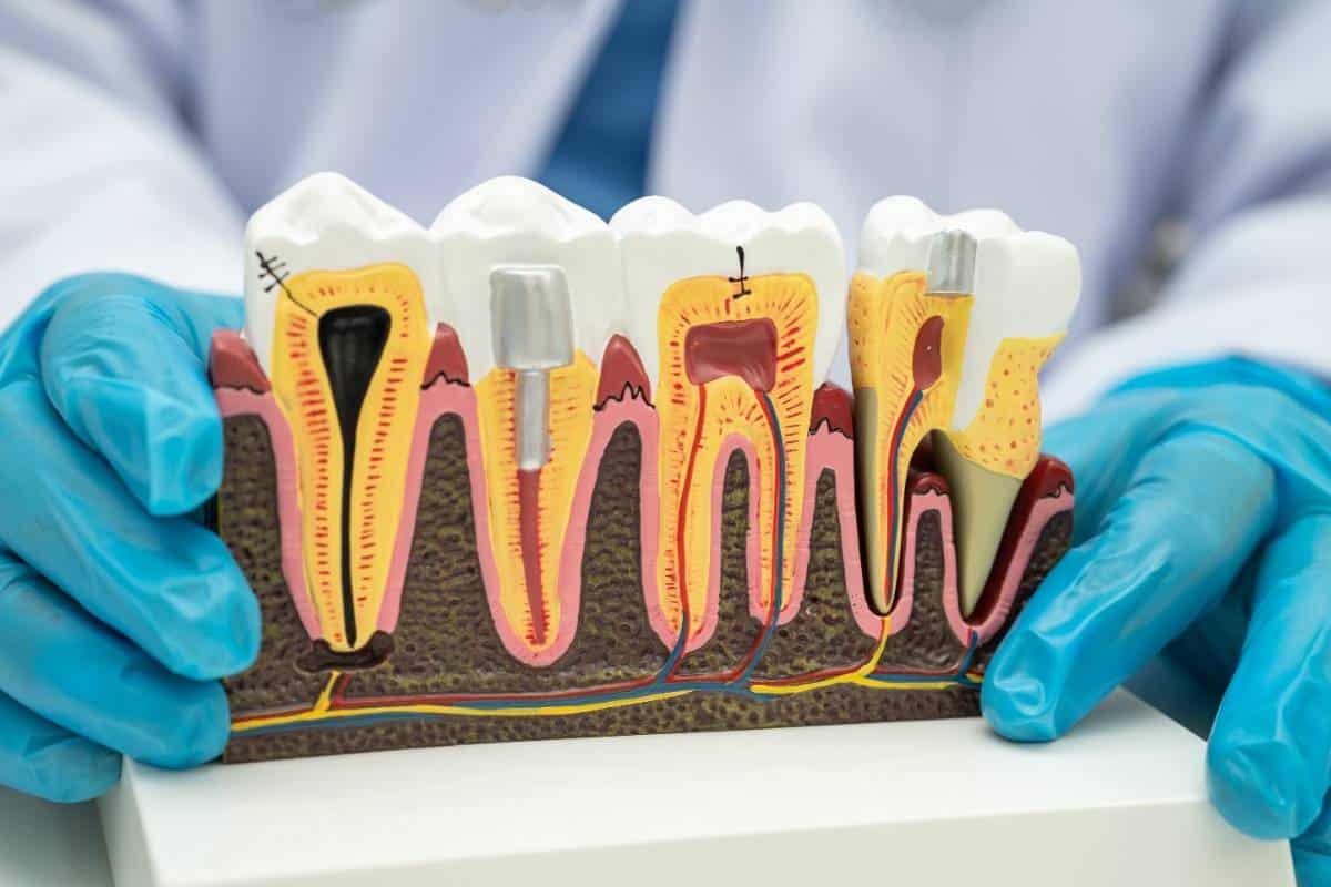 Root Canal Therapy in Lees Summit
